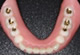 イボカップシステムデンチャー1～4歯